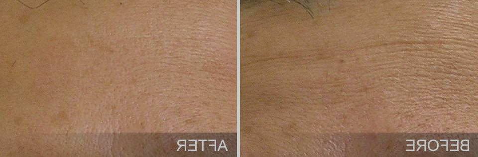 hydrafacial, nutricionista, resultados, pele-lisa