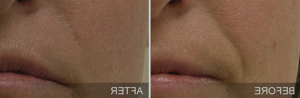 hydrafacial, nutricionista, resultados, rugas